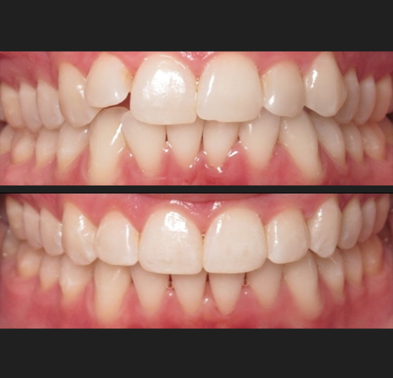 invisalign-8