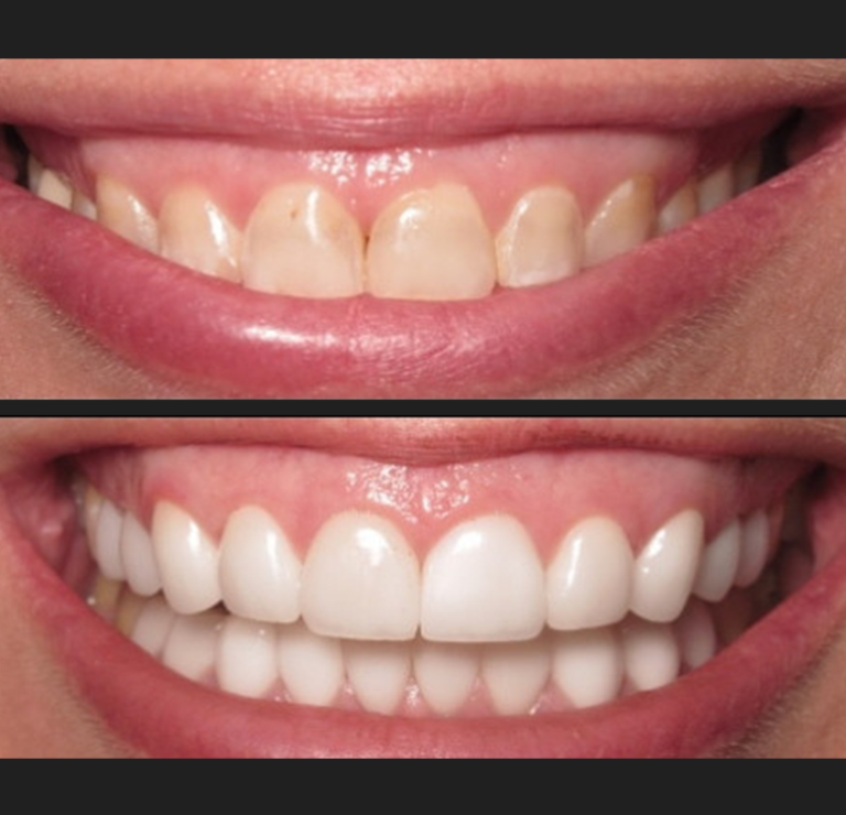 smilemakeover1