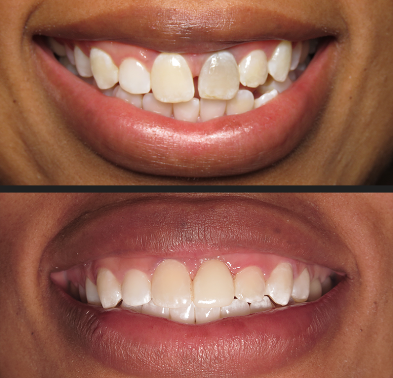 smilemakeover4