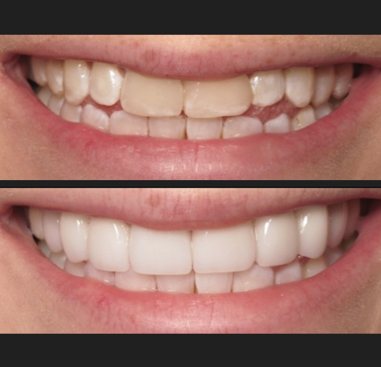 veneers3