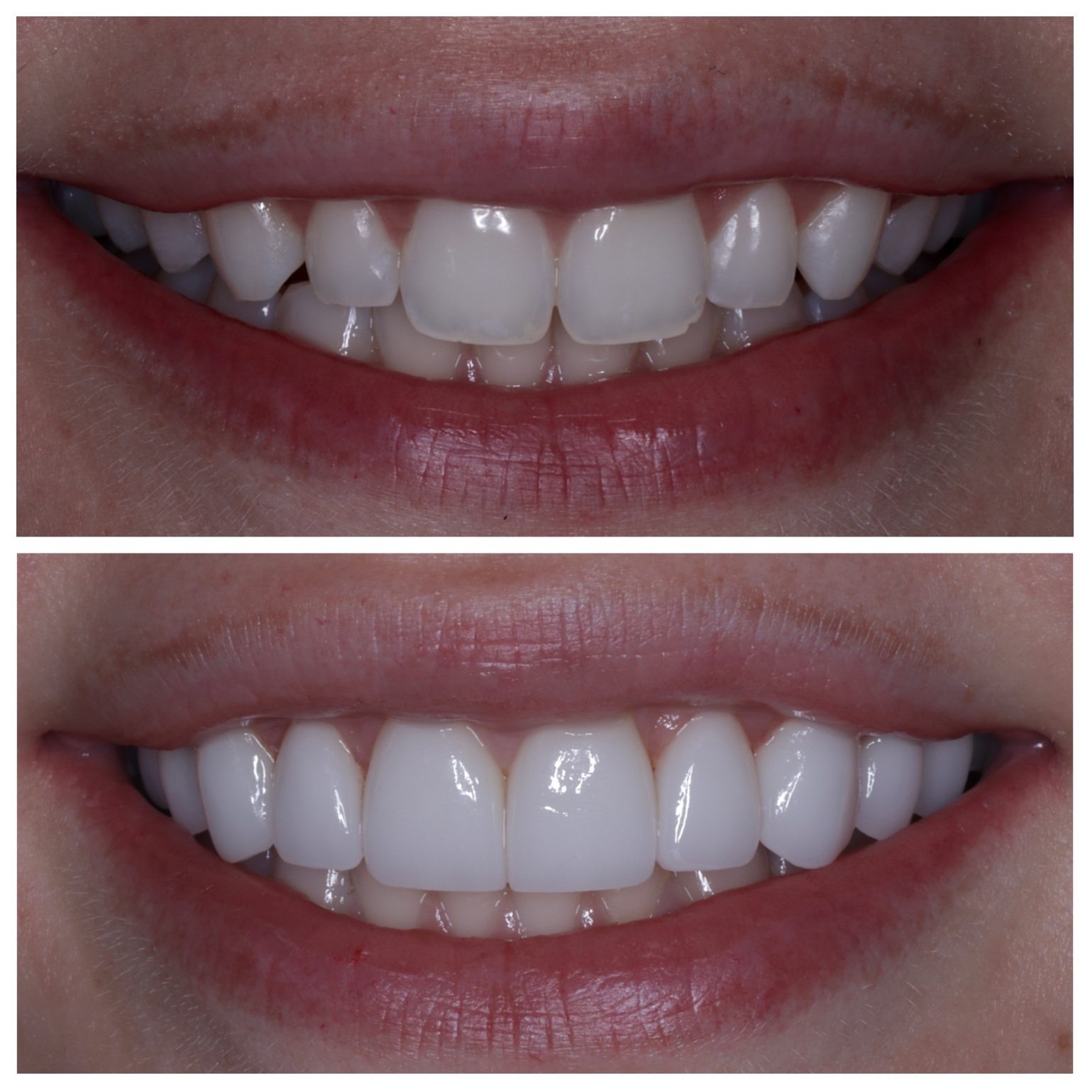 Veneers Charlotte NC Charlotte Veneers Porcelain Pearl