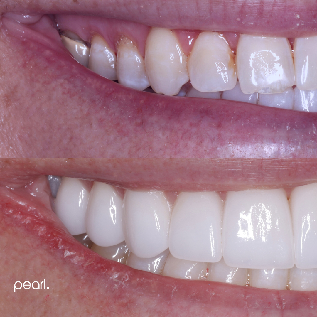 Teeth Whitening Myth Busting! Charlotte Dentist Best Cosmetic