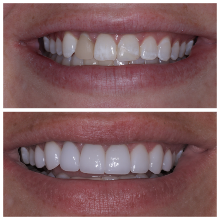Invisalign