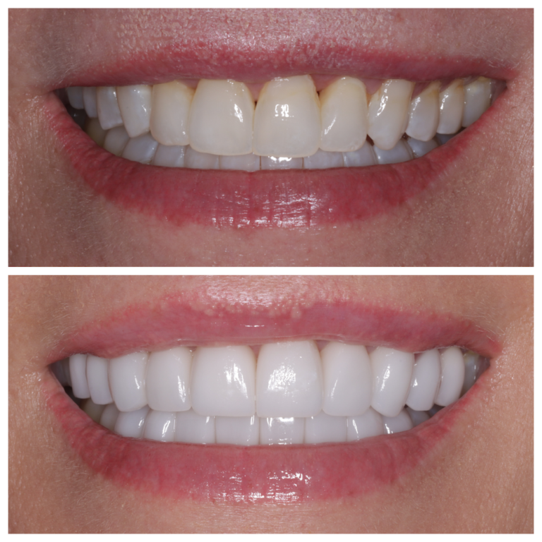 Invisalign1