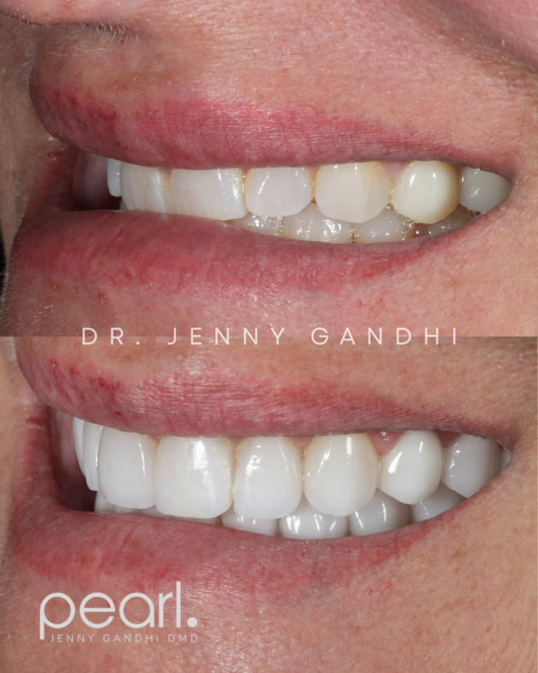 no-prep veneer