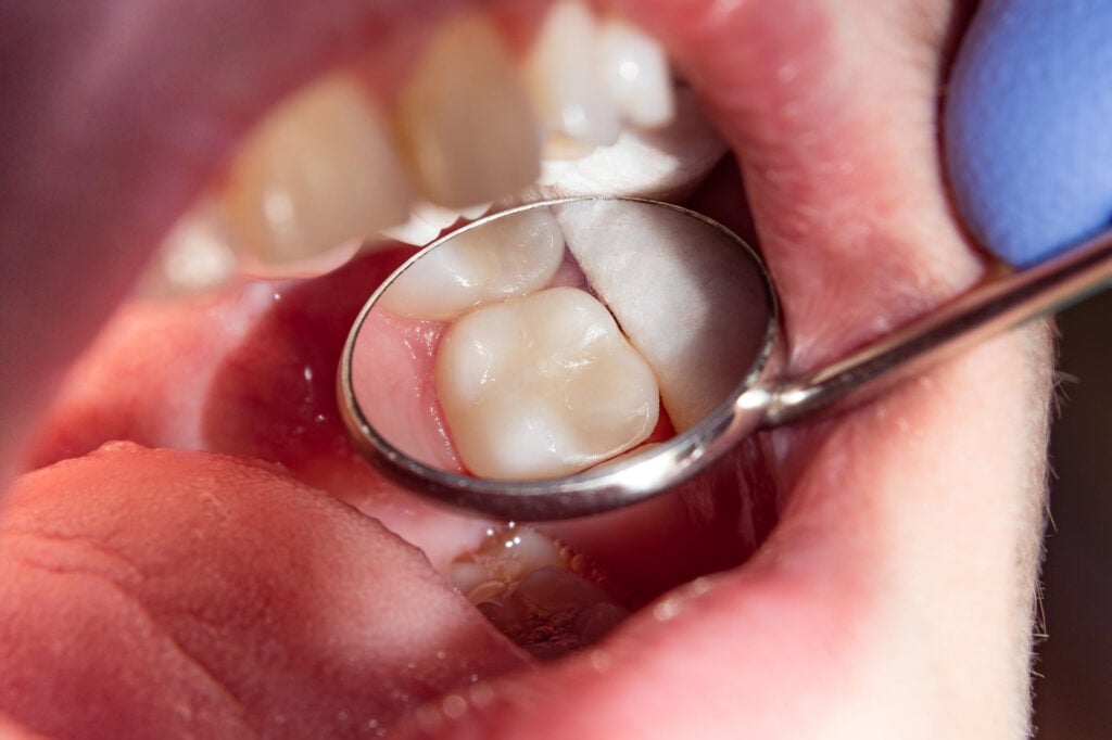 close up of a mouth that has tooth-colored fillings in Charlotte, NC