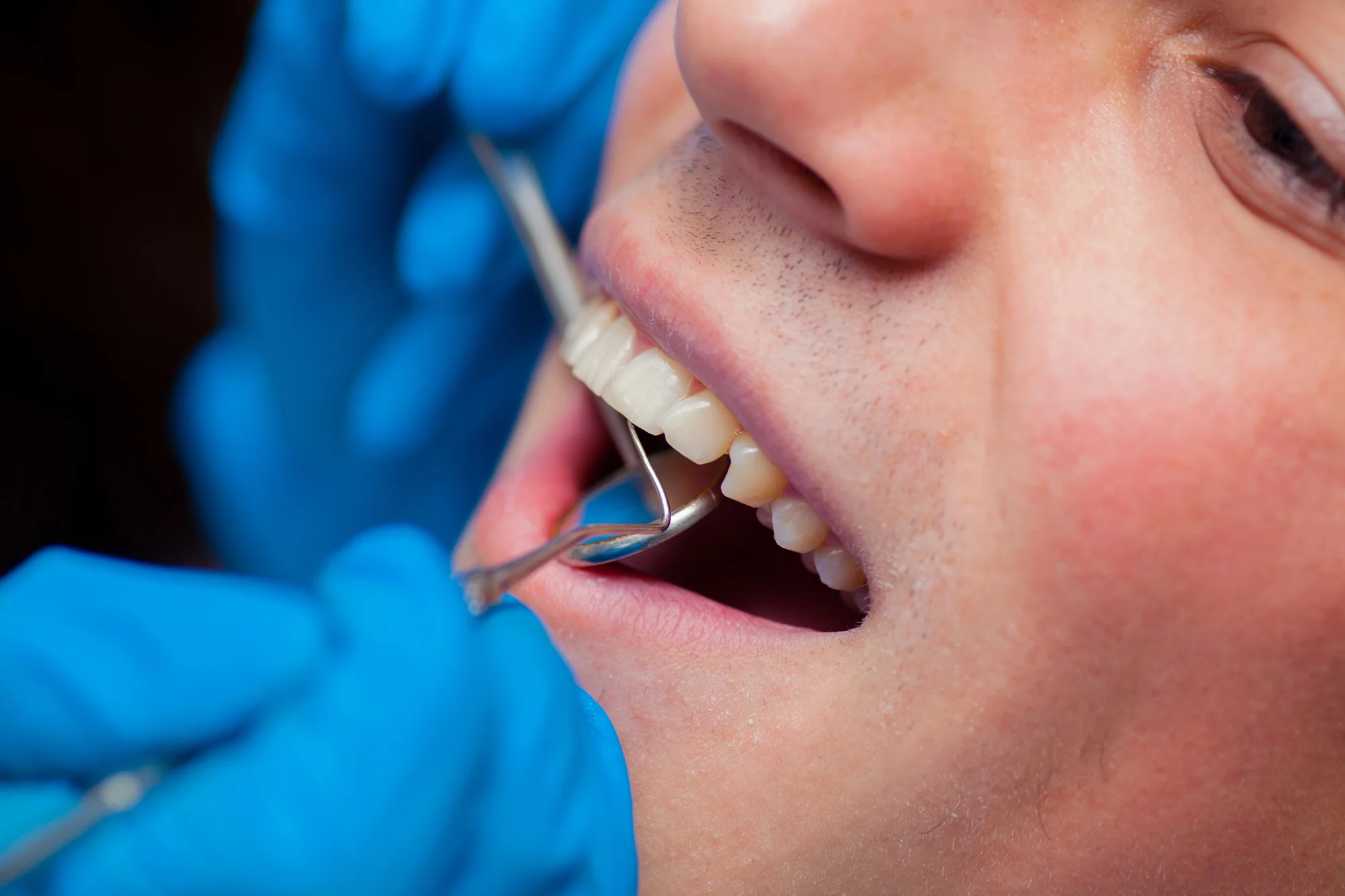 man at the dentist for tooth-colored fillings in Charlotte, NC