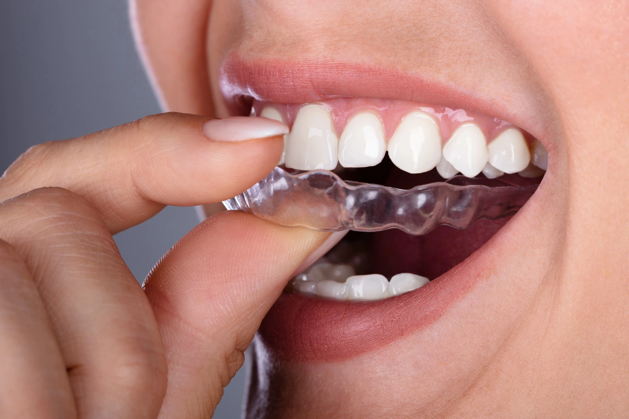 woman about to wear Invisalign in Charlotte, NC