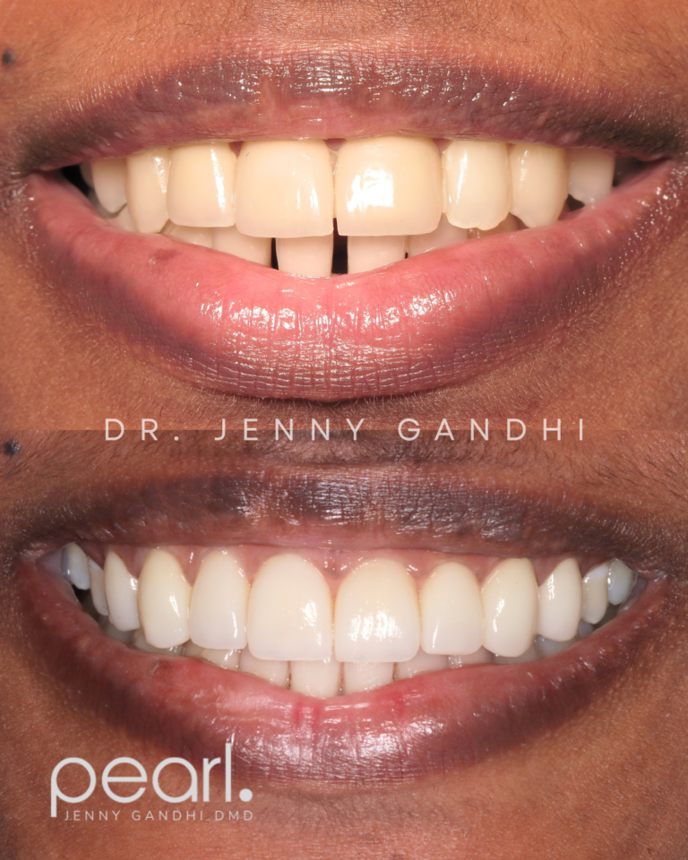 Invisalign_Veneer
