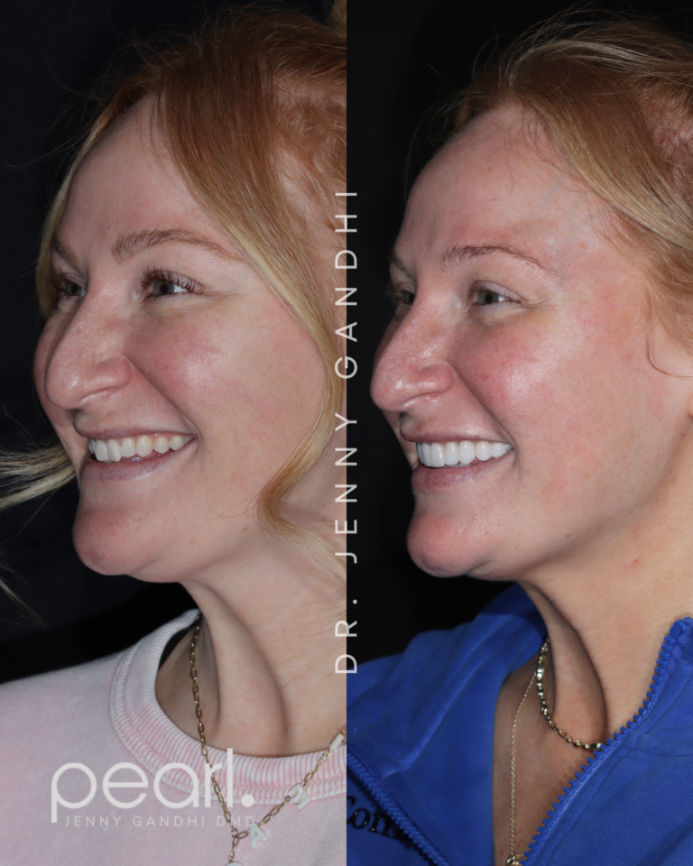 Veneer (4)