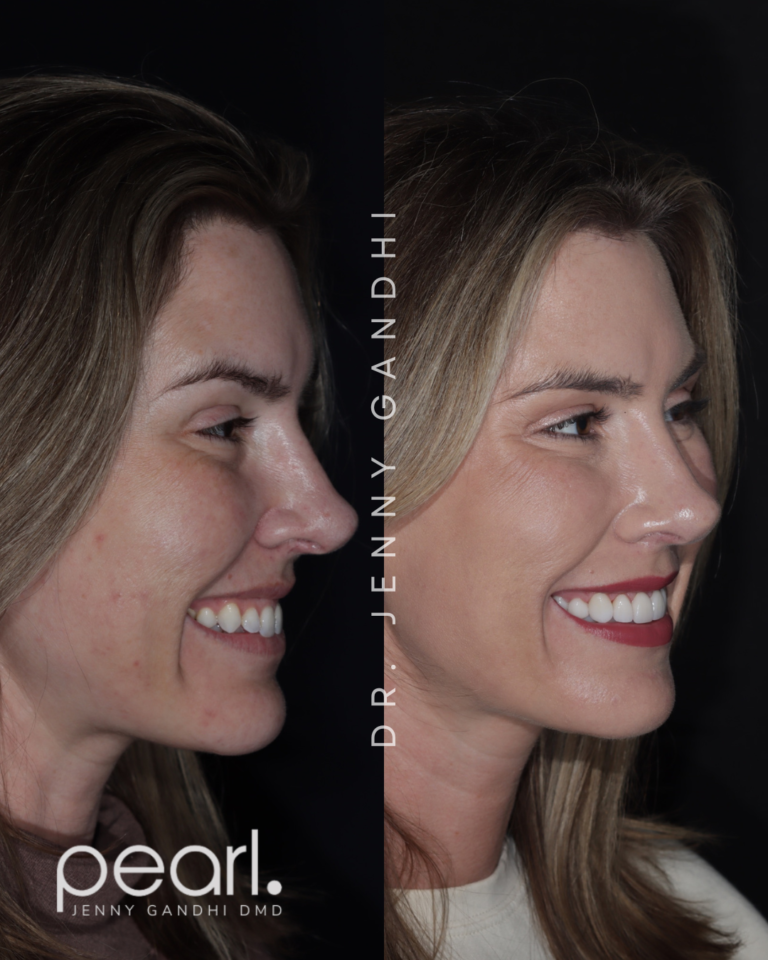 Veneer_Gingival Recontouring_Botox