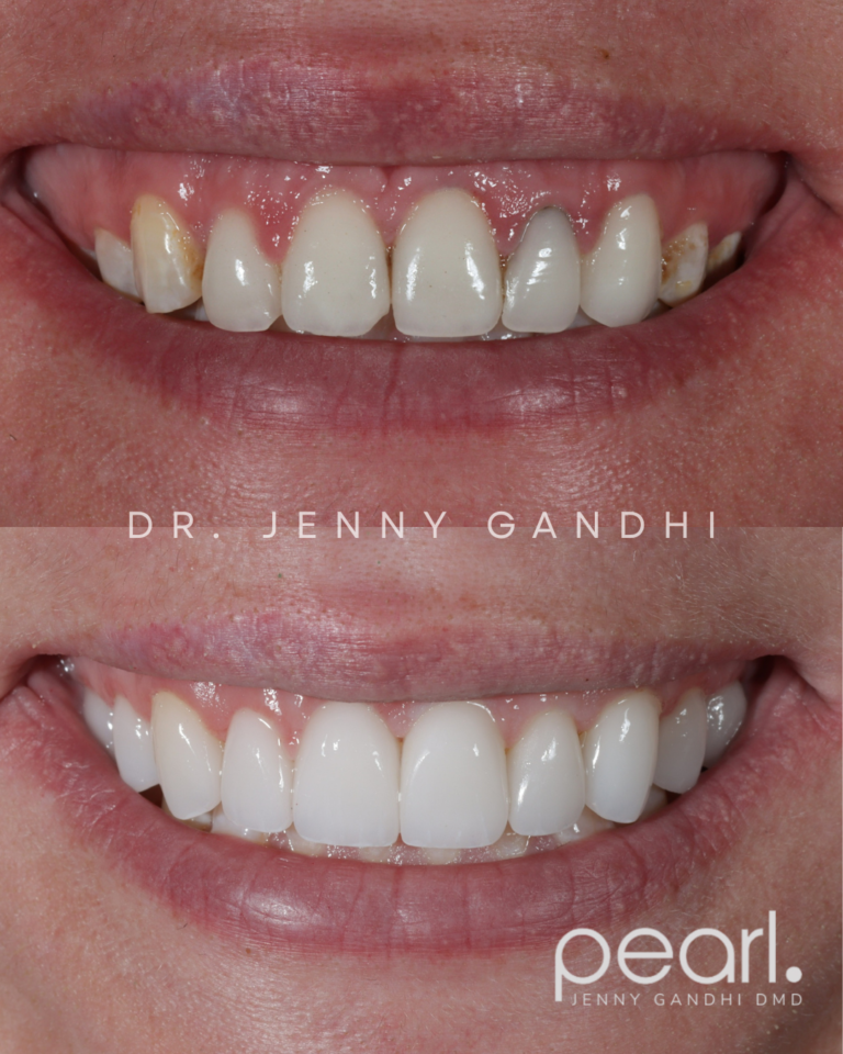 Veneer_Gum Recontouring (1)