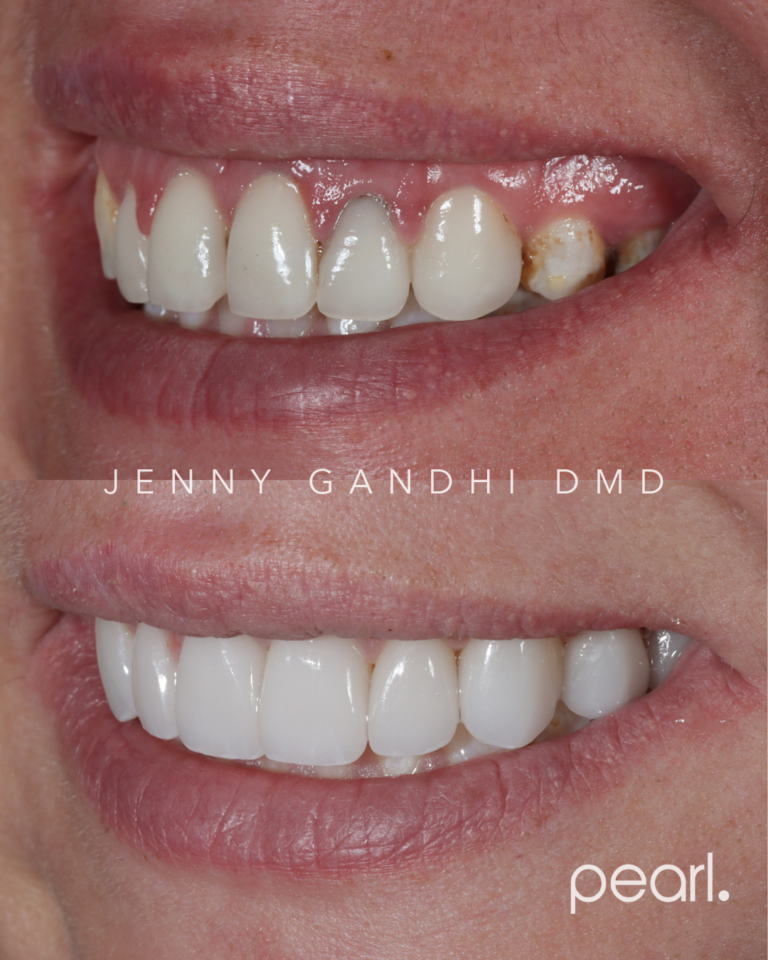 Veneer_Gum Recontouring (2)