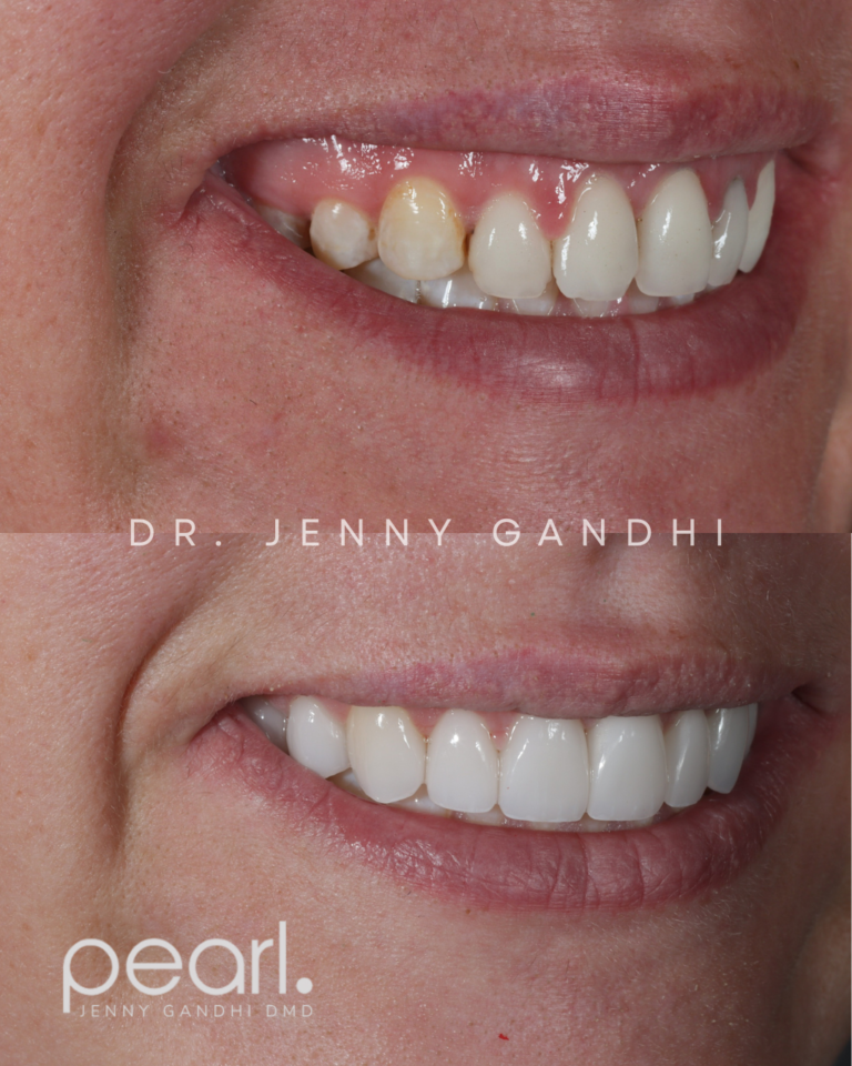 Veneer_Gum Recontouring
