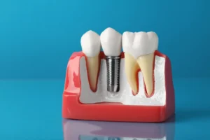 dental implants at a dentist in Myers Park, Charlotte, NC
